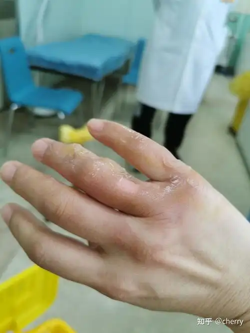 烫伤记录 - 知乎