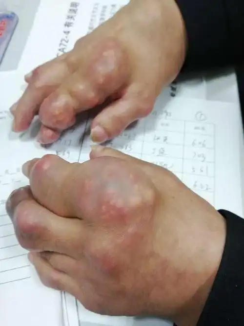 痛风的许多为什么,痛风小贴士告诉您!