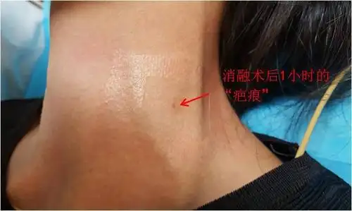 手术切除甲状腺肿物与超声引导下的热消融甲状腺肿物的区别 - 好大夫