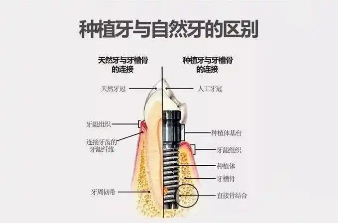 种植牙大科普一颗完整种植牙组成