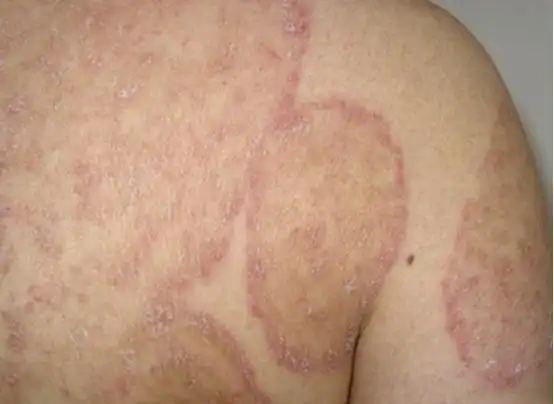 好发部位是除手,足,会阴和股部以外的光滑皮肤,多见于腰腹,臀部和躯干
