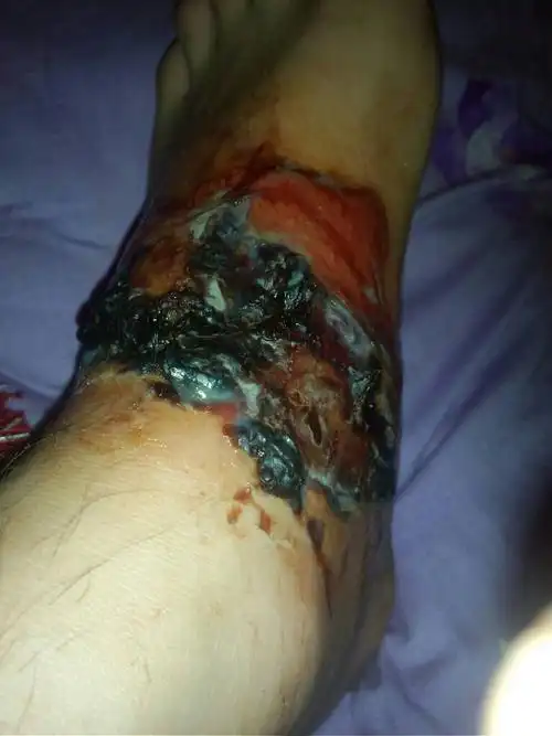 我的脚被开水烫伤,没去医院,已经一个礼拜多了.这样有什么问题吗?