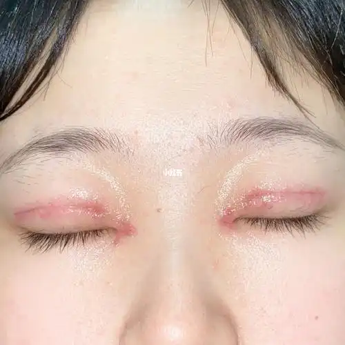 双眼皮全切提肌开眼角贺新强拆线即刻_开眼角_全切双眼皮_双眼皮手术