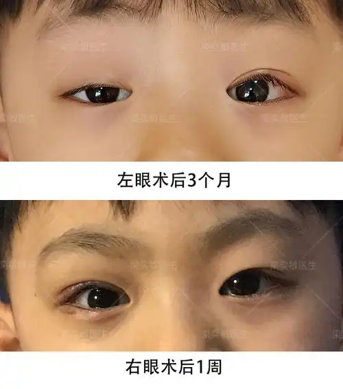 先天性中重度双眼上睑下垂矫正案例分享 - 好大夫在线