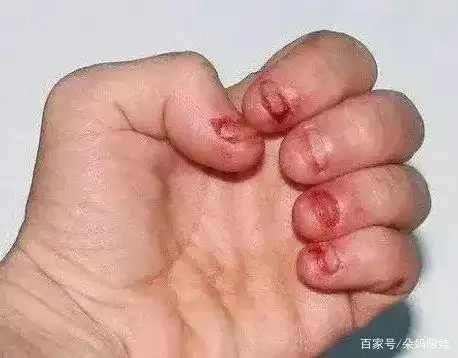 "手指被啃烂,血肉模糊!"爱啃指甲的孩子,真的不知道疼吗?