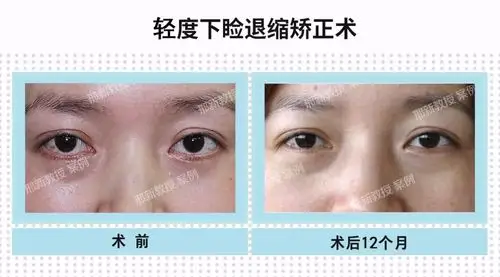 下睑成形术后下睑退缩的矫正及典型病例