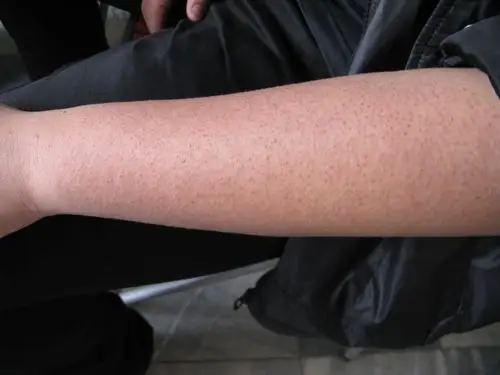 14岁患儿,毛囊炎求助