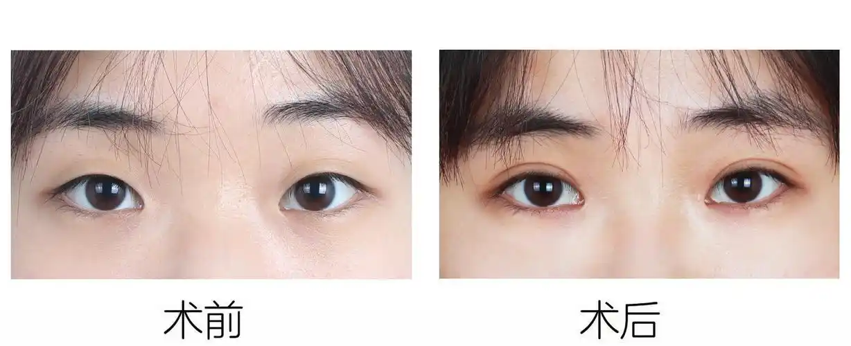 从平淡单眼皮到妈生双眼皮丨案例分析