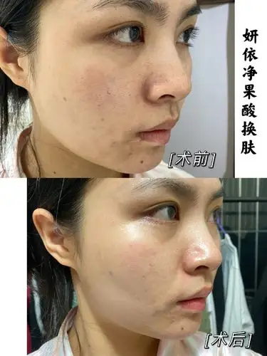 这一次体验的是妍依净的果酸换肤.
