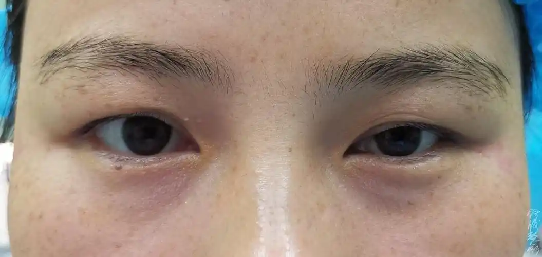 平时上眼皮遮住了部分瞳孔,为了看清和视线更好一些,会代偿性的额部