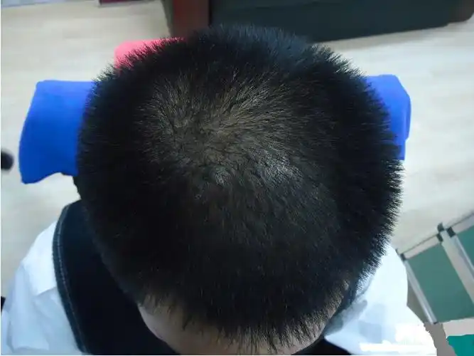 现在头发越来越少了,头皮一直都很油,会是出油的原因导致的吗?有办