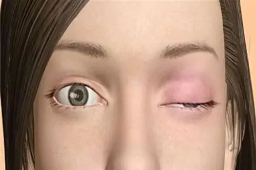 重症肌无力微创手术治疗新篇章