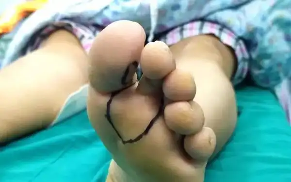 脚趾成功变成大拇指患者感激医生再造之恩