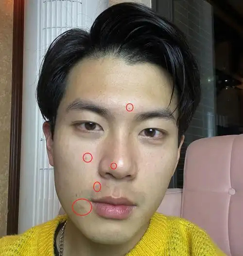 男生皮肤很油,毛孔粗大怎么改善?