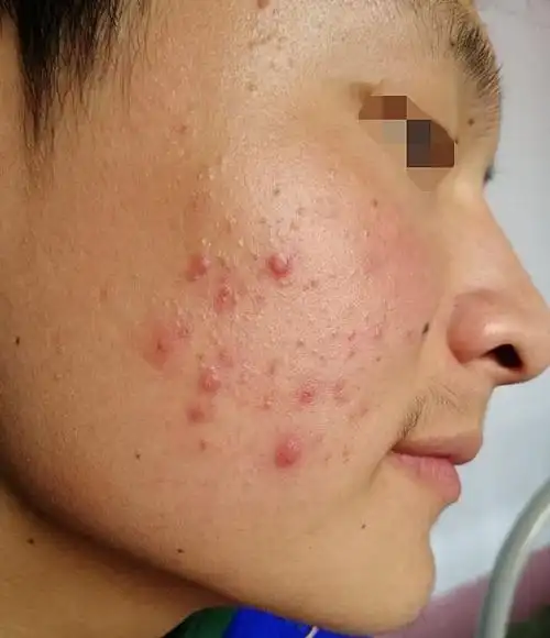 男生脸上长混合型痤疮,有毛囊炎和闭口粉刺