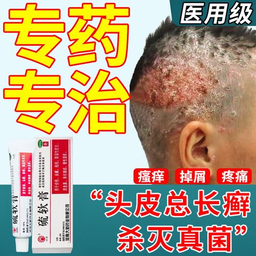 头癣特药效可搭洗发水头发毛囊炎细菌真菌感染头皮屑多治疗 去屑药头