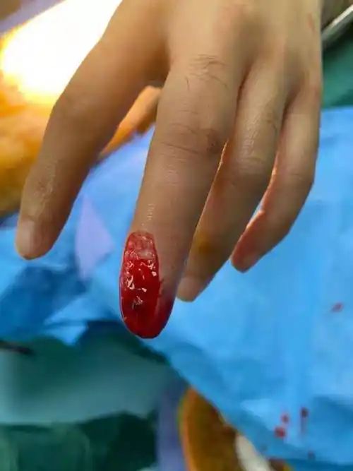 【原创】咔嚓,一刀剁下半个手指!
