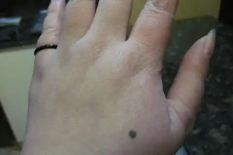 手背上有痣的人一定大富大贵吗