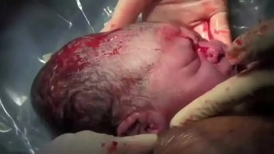 宝宝头露出来的时候,医生会先用手抹宝宝的鼻子,然后另一个医生就会拿