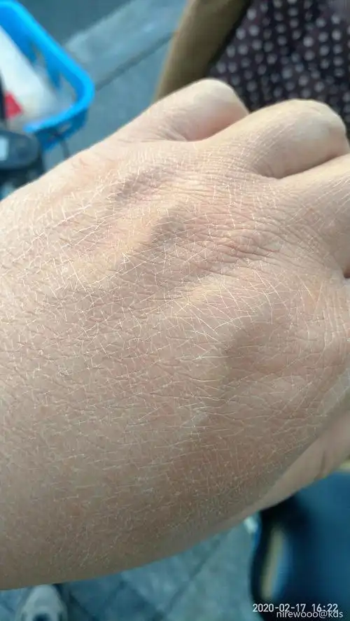 手背上的皮肤一夜之间变成这样了!