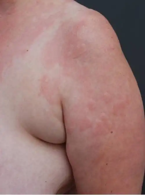 图文盘点肢端分布的血管性皮肤病