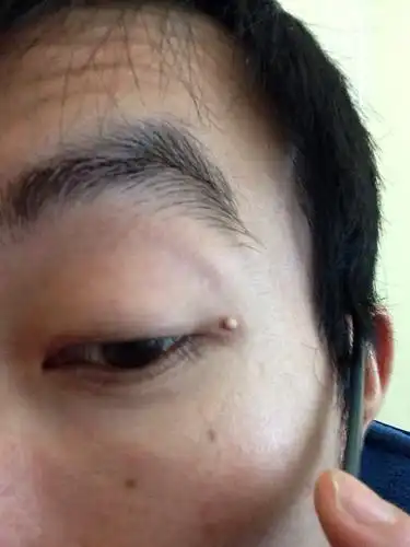 眼睛边上长了个白色颗粒,不是脓包,不痛不痒,有知道这是什么的么?