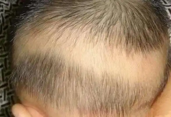 新生儿佝偻病图片_新生儿佝偻病症状表现图片大全_有来医生