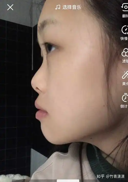 塌到什么程度呢 就是小时候的鼻子没长大的感觉 就是侧脸拍会看到另