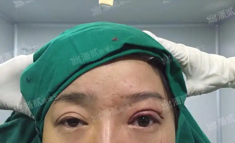 眼皮提拉术需要多少钱(提肌上睑下垂失败后留阴影)