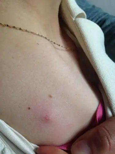 请问我后背起了一个豆豆,特别疼,是什么