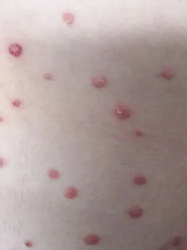 急性点滴型银屑病的元凶原来是你! - 好大夫在线