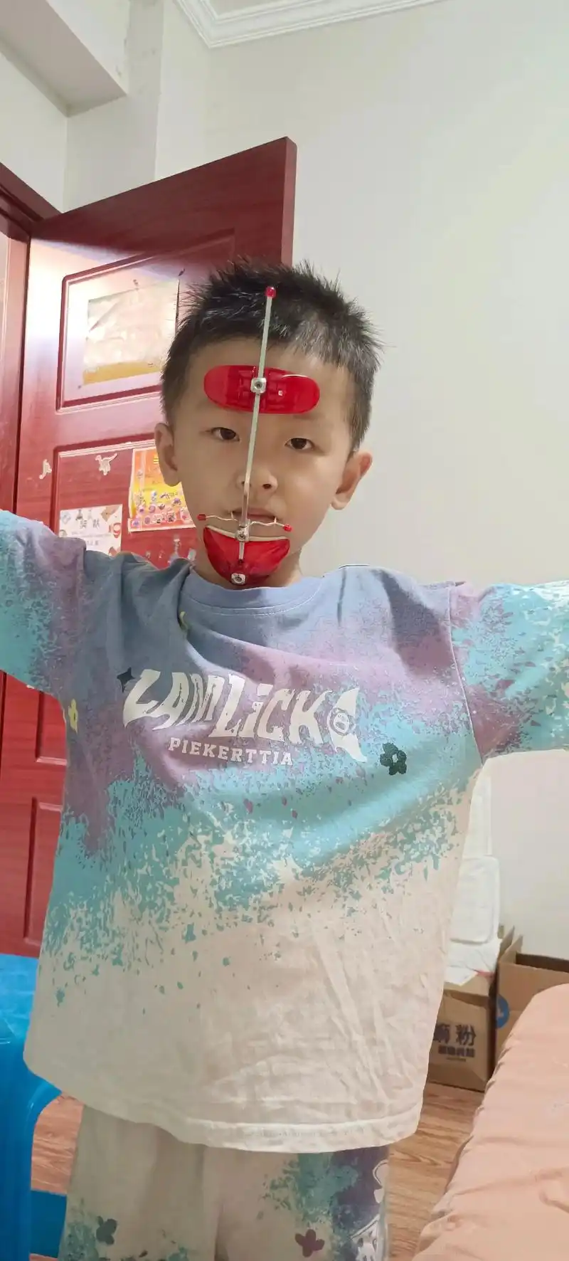 牵引器矫正一个半月 还是有变化的 #反颌矫正 地包天矫