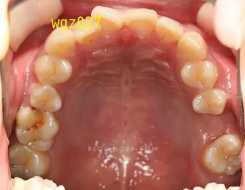 正畸手段关闭上颌第一磨牙拔牙间隙案例原创武广增