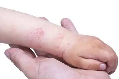 夏季天气炎热,宝妈们做好这3点,帮宝宝预防"湿疹"症状!