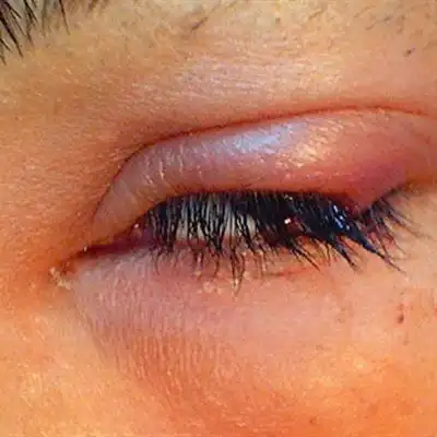 上眼皮肿是怎么回事?_眼睑