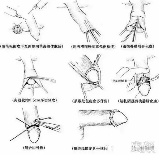 蕞新技术[无痛][快速][美观]—应用吻合器行包皮环切术-蜜颜优惠