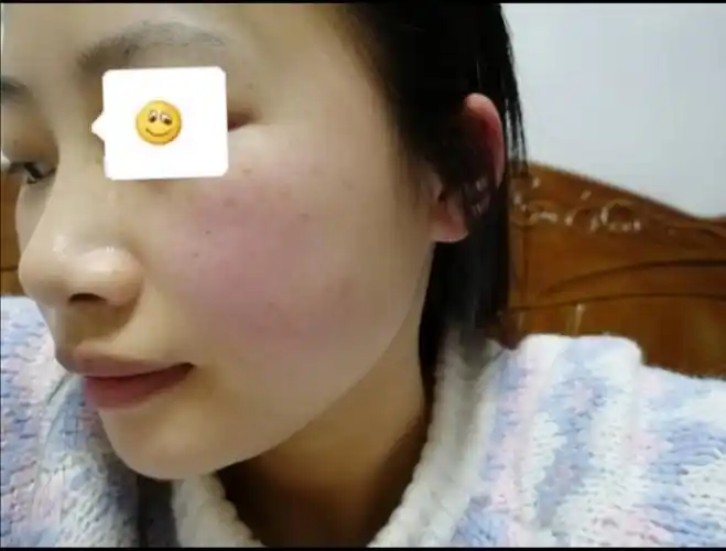 皮肤泛红刺痛的姐妹看过来