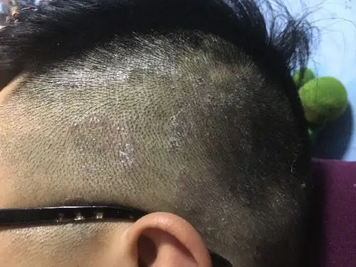 洗好头,头皮有白白的一块,搓一下像头皮屑一样掉下来,还有的抠下来有