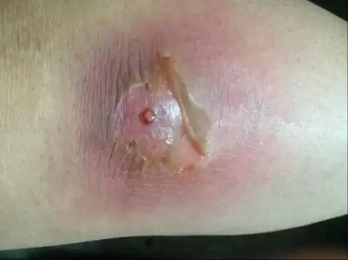 火疖子也叫疖疮,疖子是一种化脓性毛囊及毛囊深部周围组织的感染;痈则