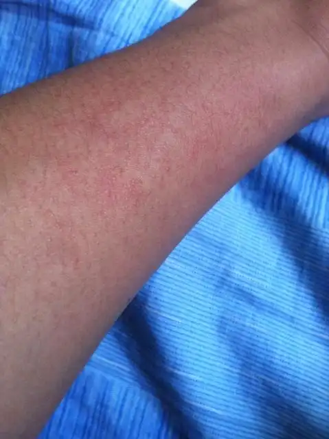 夏天太阳晒后胳膊上有疙瘩很痒.