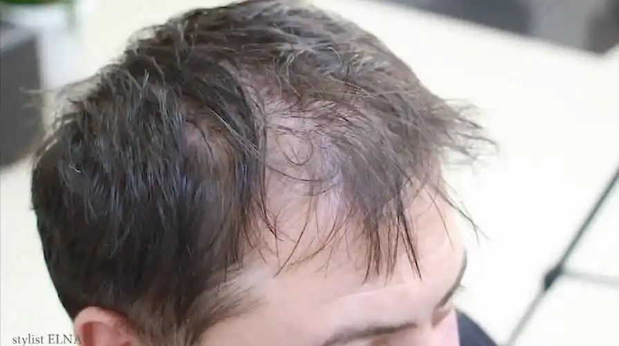 45岁男子头顶发量稀少很烦恼,发型师这样剪,帅到不敢认