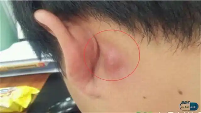 耳朵后面长了个硬包是咋回事?医生:要警惕这几种问题