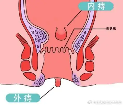 痔疮#