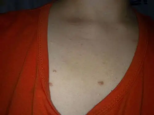 阴茎长毛囊炎的症状图片