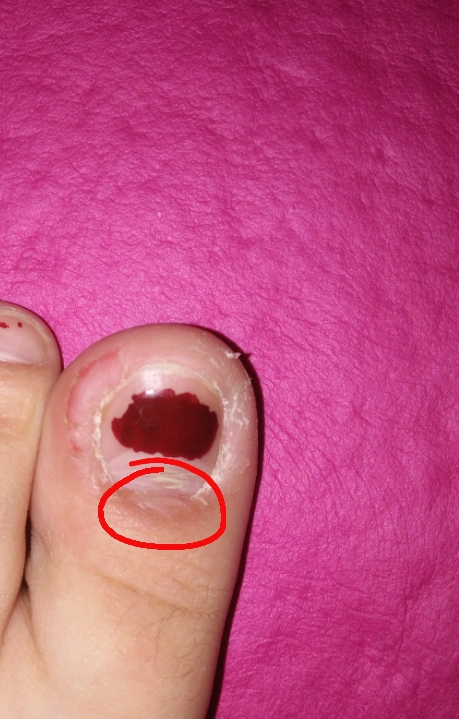 脚的大拇指根部就是与新长出指甲相连的那块如图抠肉肿了一按就痛怎么