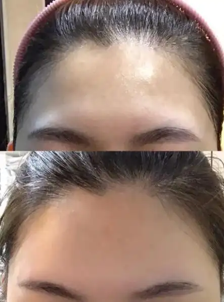 了解注射玻尿酸填充额头的好处,丰额头注射玻尿酸效果维持多久?