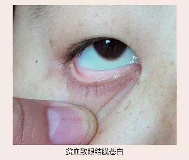 嘴唇,手和脚的甲床,当血量不足,这些地方就会变为白色,是贫血的明显