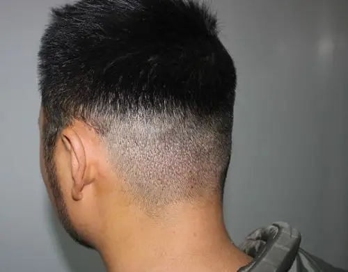 关于植胡须手术?