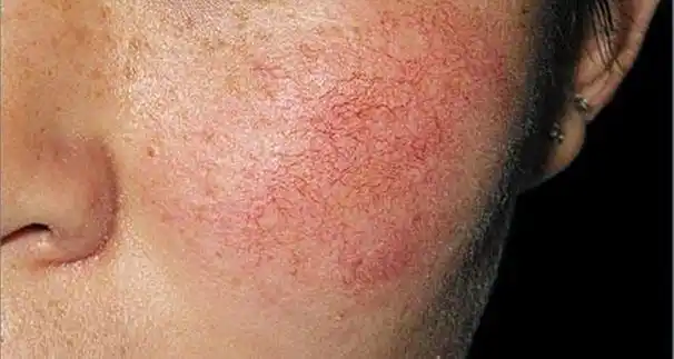 任何皮肤问题去红血丝是第一步来看看三甲医院医生怎么说