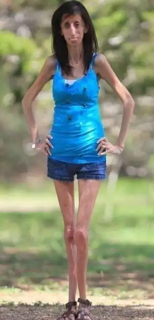 全球最瘦女孩仅27公斤,骨瘦如柴长相畸形